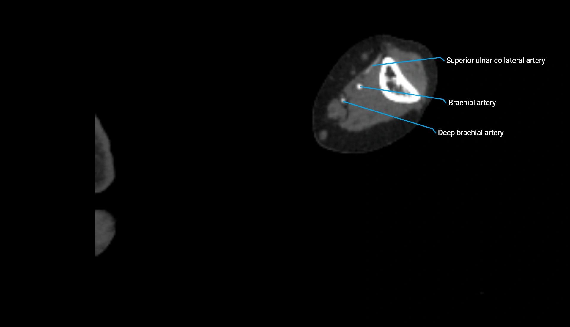 CTA upper limb axial cross sectional anatomy labelled image 204 (2).webp